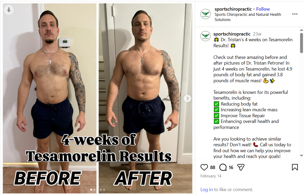 Tesamorelin Before and After Men